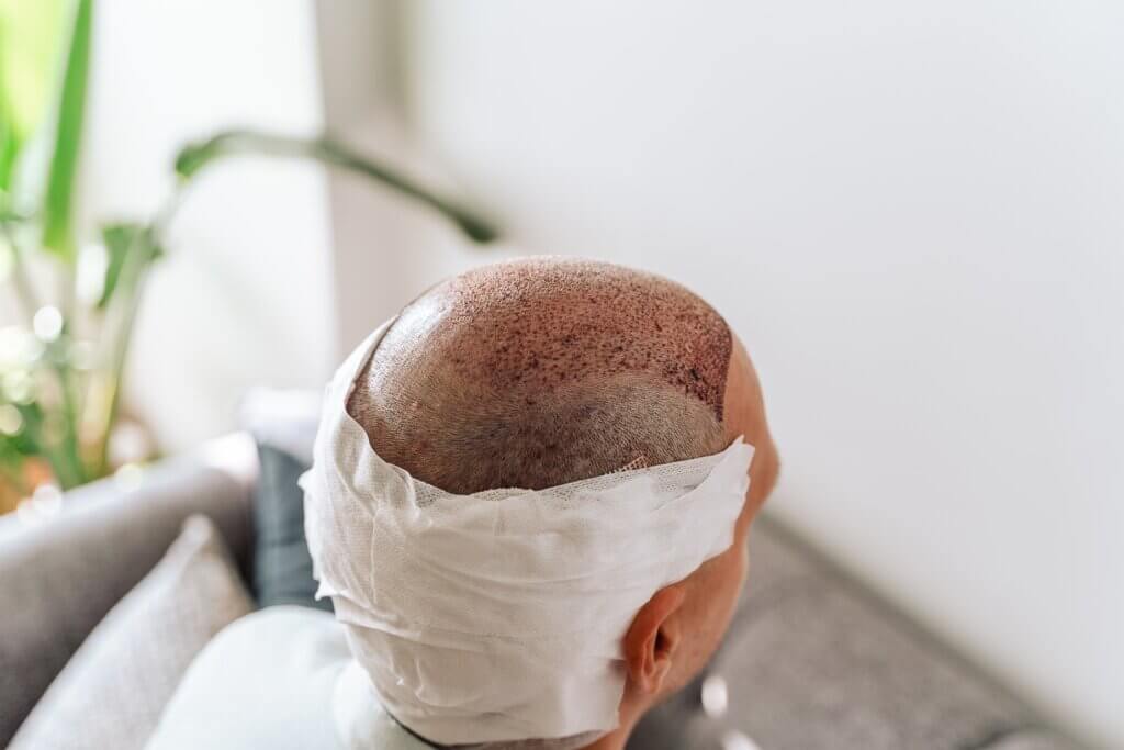 What is the FUE hair transplant procedure
