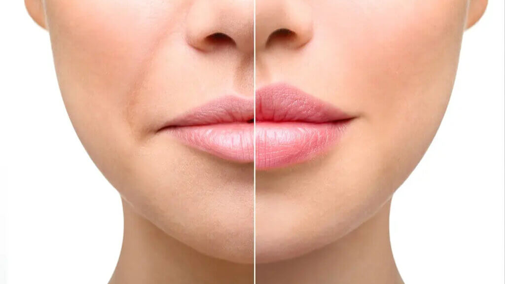 what is lip augmentation surgery